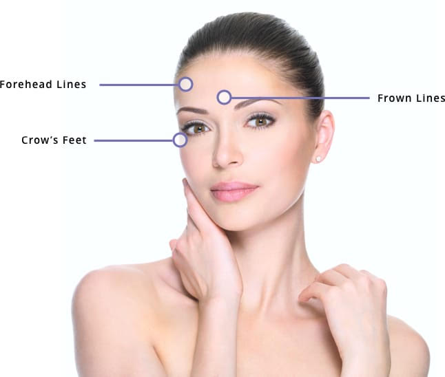 Anti-Wrinkle Treatment - 2 Areas - NV Aesthetics