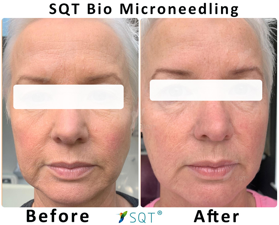 sqt anti-ageing