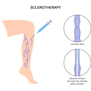 Sclerotherapy